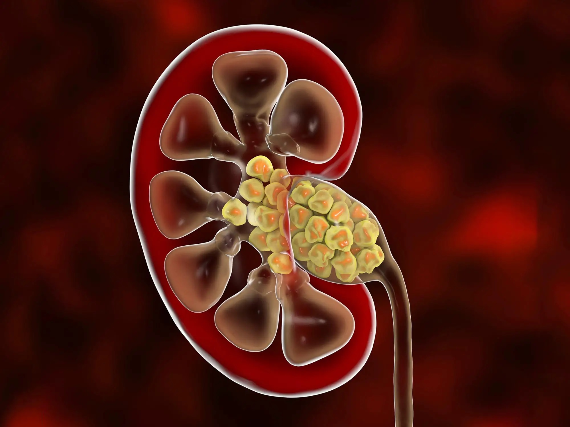 How to Manage Pain During a Kidney Stone Attack