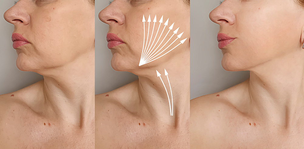 How Long Does Face Thread Lift Last: Unveiling the Secrets to Youthful Skin